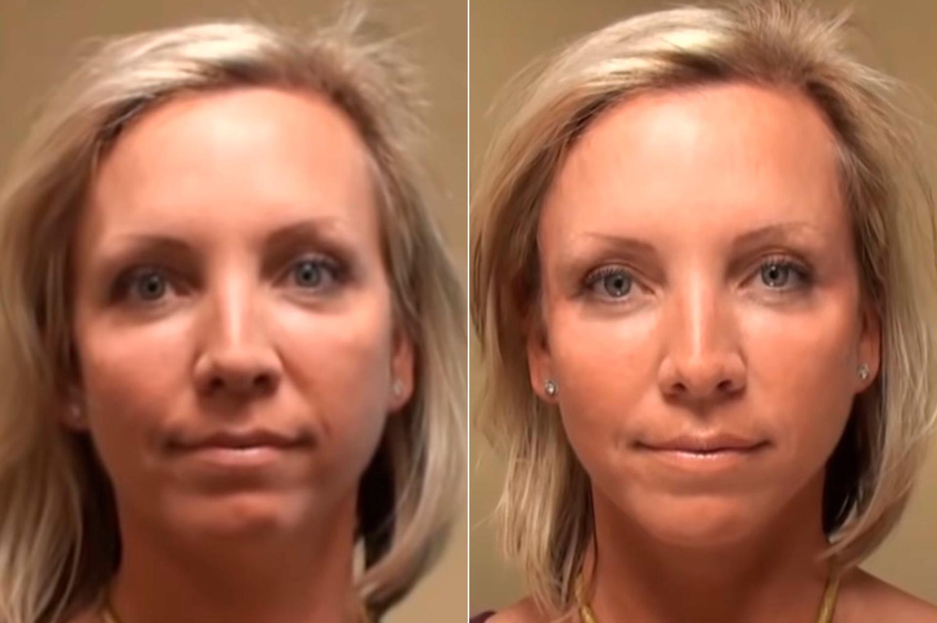 Donath Facial Plastic Surgery: Dr. Alexander Donath, MD, FACS result — Cincinnati, OH