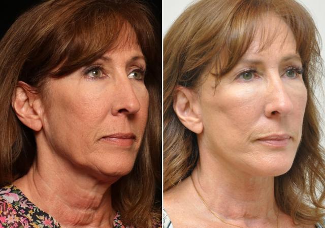 Neck Liposuction result at Donath Facial Plastic Surgery: Dr. Alexander Donath, MD, FACS in Cincinnati, OH