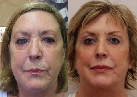 Facelift result at Donath Facial Plastic Surgery: Dr. Alexander Donath, MD, FACS in Cincinnati, OH