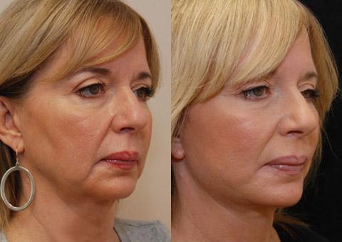 Donath Facial Plastic Surgery: Dr. Alexander Donath, MD, FACS facelift result — Cincinnati, OH