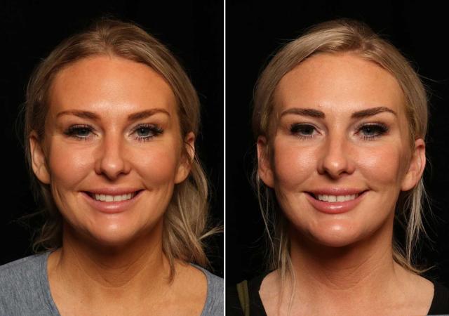 Neck Liposuction result at Donath Facial Plastic Surgery: Dr. Alexander Donath, MD, FACS in Cincinnati, OH