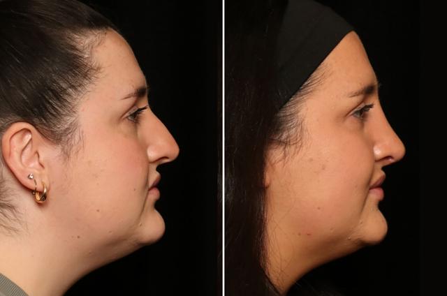 Functional Rhinoplasty result at Donath Facial Plastic Surgery: Dr. Alexander Donath, MD, FACS in Cincinnati, OH