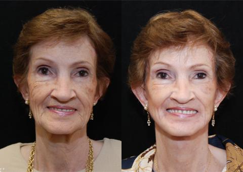 Laser Skin Resurfacing result at Donath Facial Plastic Surgery: Dr. Alexander Donath, MD, FACS in Cincinnati, OH