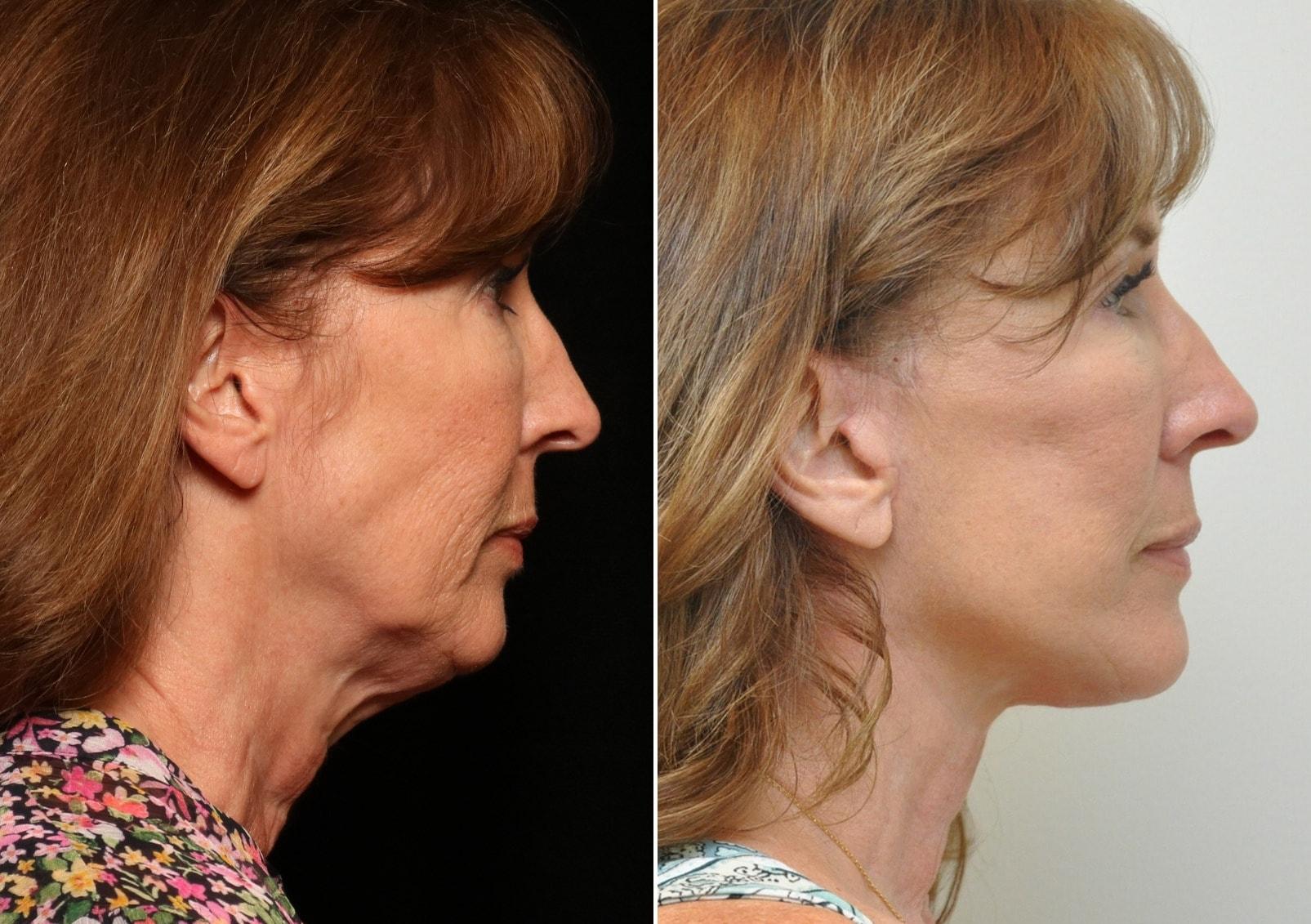 Donath Facial Plastic Surgery: Dr. Alexander Donath, MD, FACS neck liposuction result — Cincinnati, OH