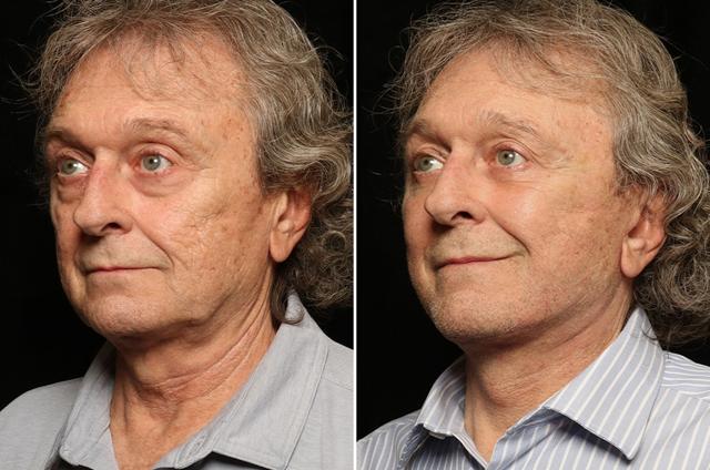 Facelift result at Donath Facial Plastic Surgery: Dr. Alexander Donath, MD, FACS in Cincinnati, OH