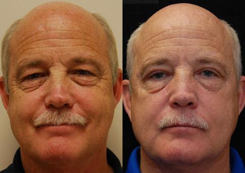 Blepharoplasty result at Donath Facial Plastic Surgery: Dr. Alexander Donath, MD, FACS in Cincinnati, OH