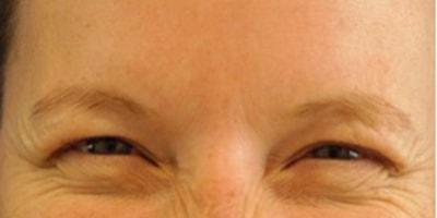 Karen M. Horton, MD botox after — San Francisco, CA