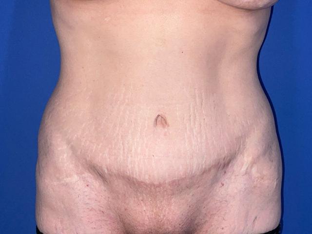 Mini Tummy Tuck after at Karen M. Horton, MD in San Francisco, CA