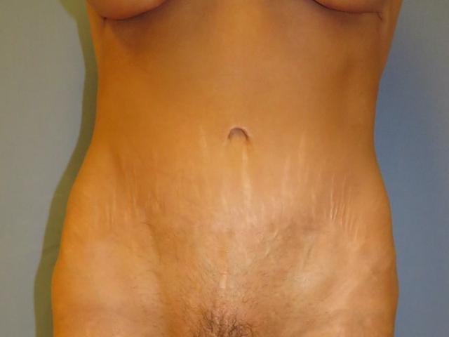 Mommy Makeover after at Karen M. Horton, MD in San Francisco, CA