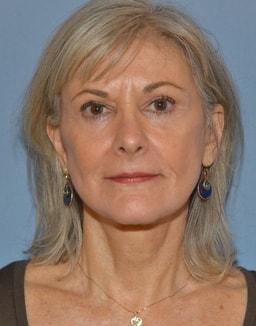 Timothy R. Miller, MD facelift after — Aliso Viejo, CA