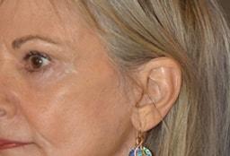 Timothy R. Miller, MD facelift after — Aliso Viejo, CA