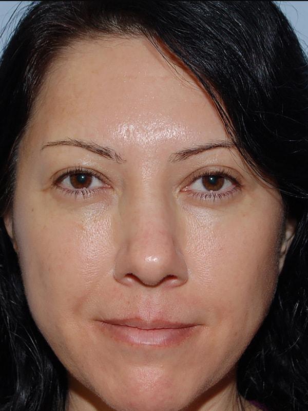 Timothy R. Miller, MD eyelid lift after — Aliso Viejo, CA