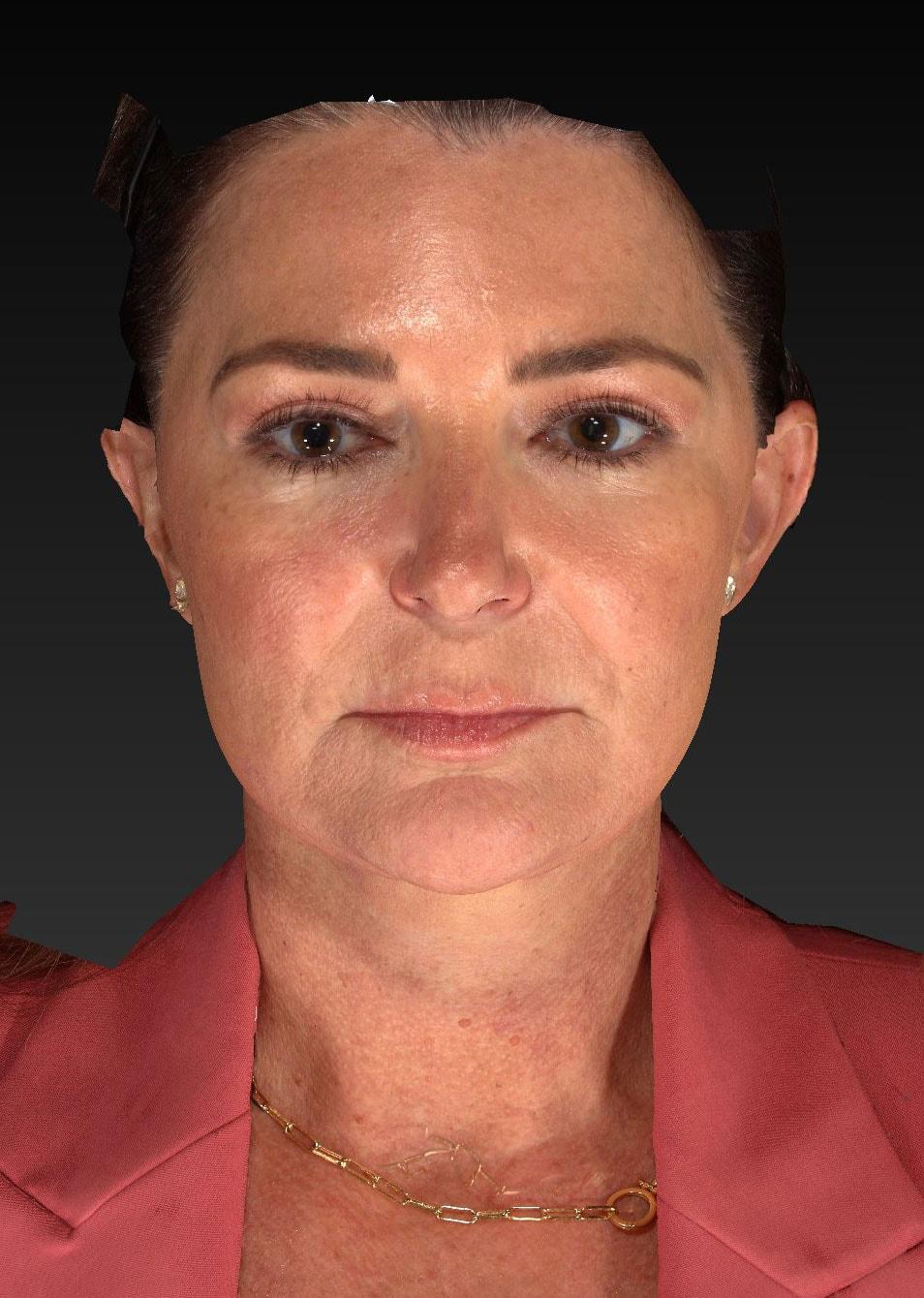 Timothy R. Miller, MD facelift after — Aliso Viejo, CA
