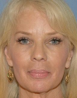 Timothy R. Miller, MD eyelid lift after — Aliso Viejo, CA