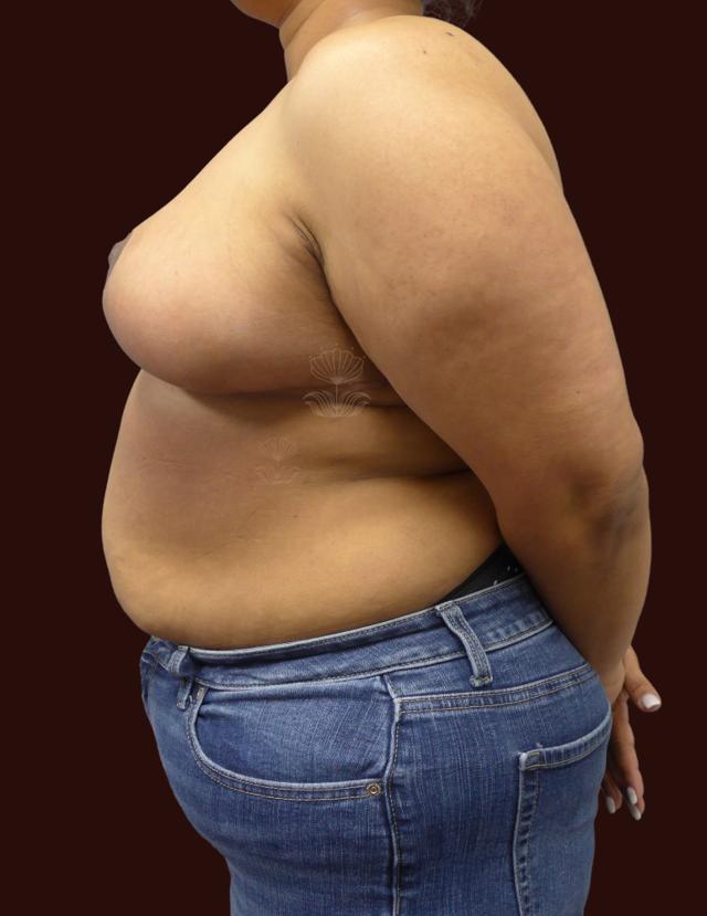 Breast Reduction after at Suma Maddox, MD in New Orleans, LA