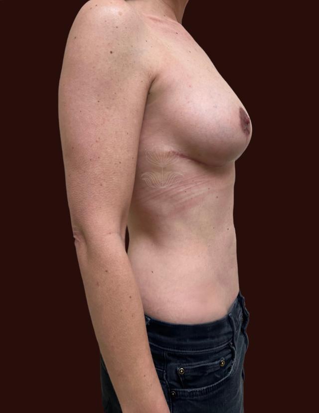 Breast Lift after at Suma Maddox, MD in New Orleans, LA