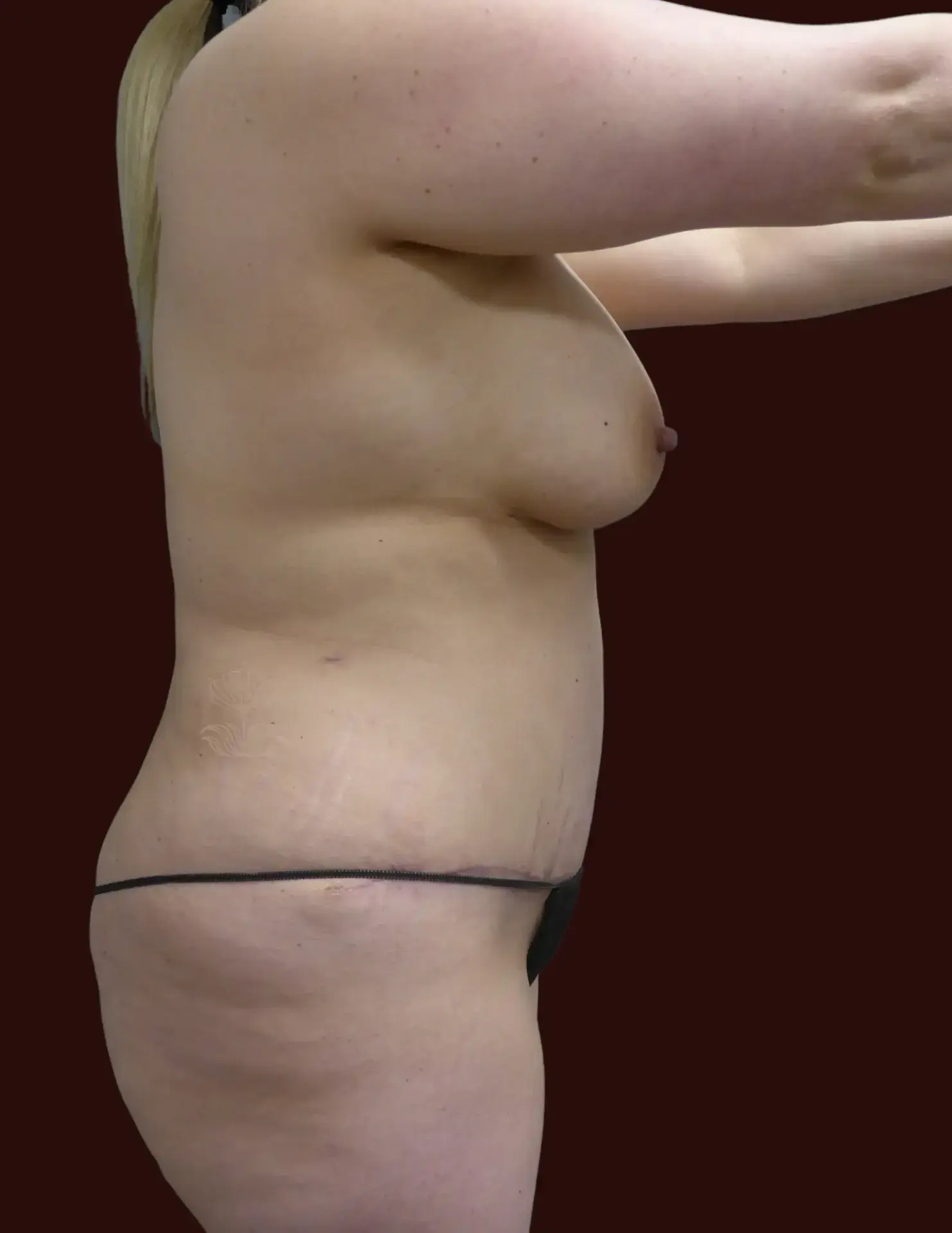Suma Maddox, MD tummy tuck after — New Orleans, LA