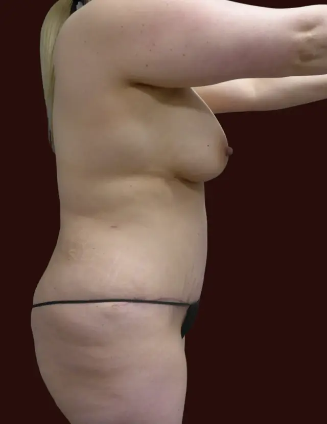 Mini Tummy Tuck after at Suma Maddox, MD in New Orleans, LA