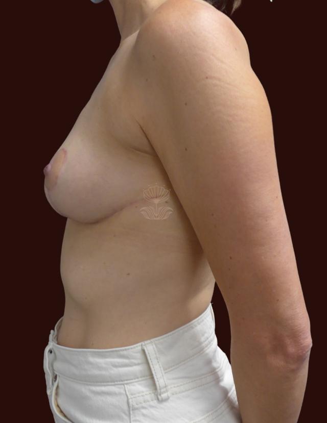 Fat Transfer Breast Augmentation after at Suma Maddox, MD in New Orleans, LA