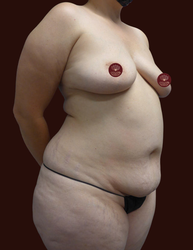 Mini Tummy Tuck before at Suma Maddox, MD in New Orleans, LA