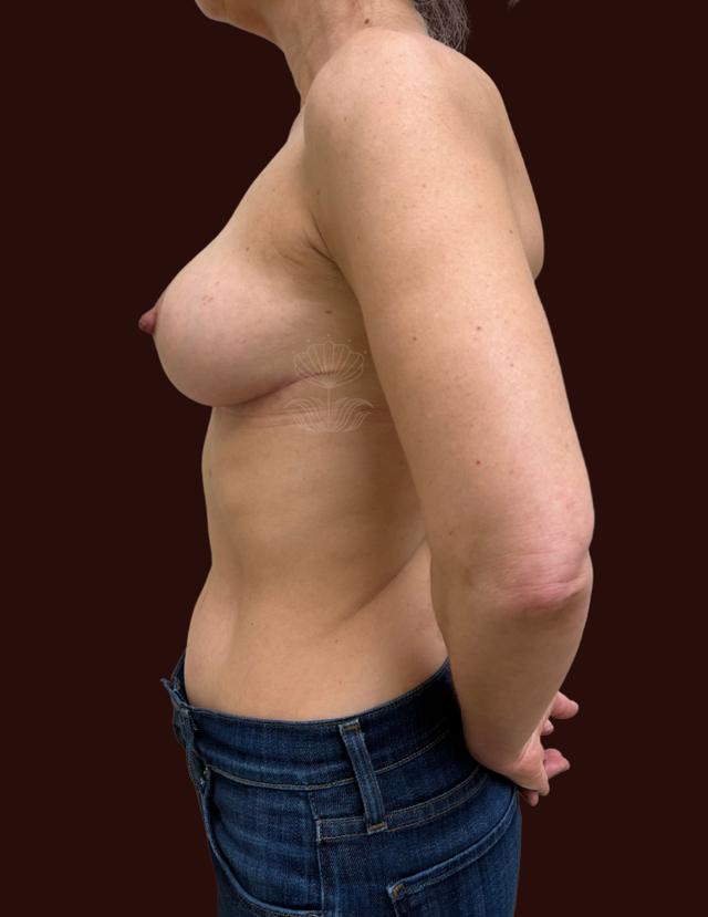 Fat Transfer Breast Augmentation after at Suma Maddox, MD in New Orleans, LA