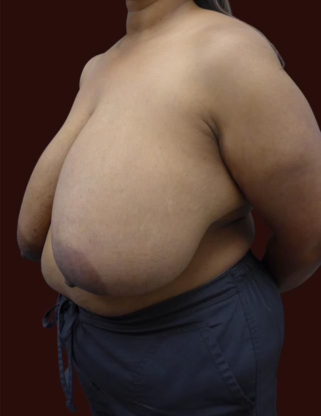 Breast Reduction before at Suma Maddox, MD in New Orleans, LA