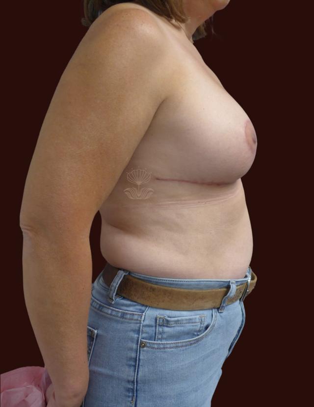 Breast Reduction after at Suma Maddox, MD in New Orleans, LA