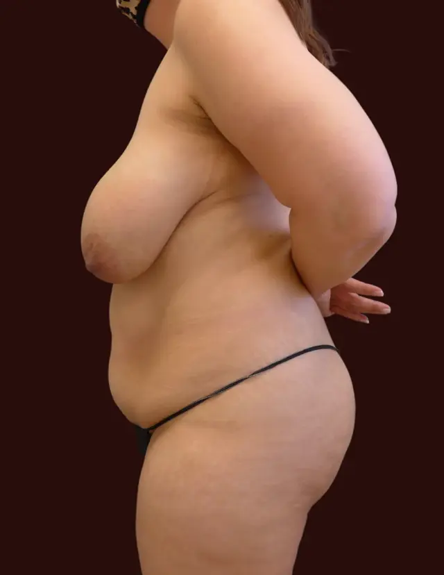 Mini Tummy Tuck before at Suma Maddox, MD in New Orleans, LA