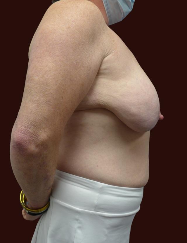 Breast Lift before at Suma Maddox, MD in New Orleans, LA