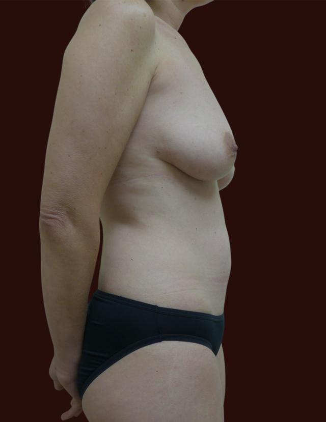 Breast Lift before at Suma Maddox, MD in New Orleans, LA