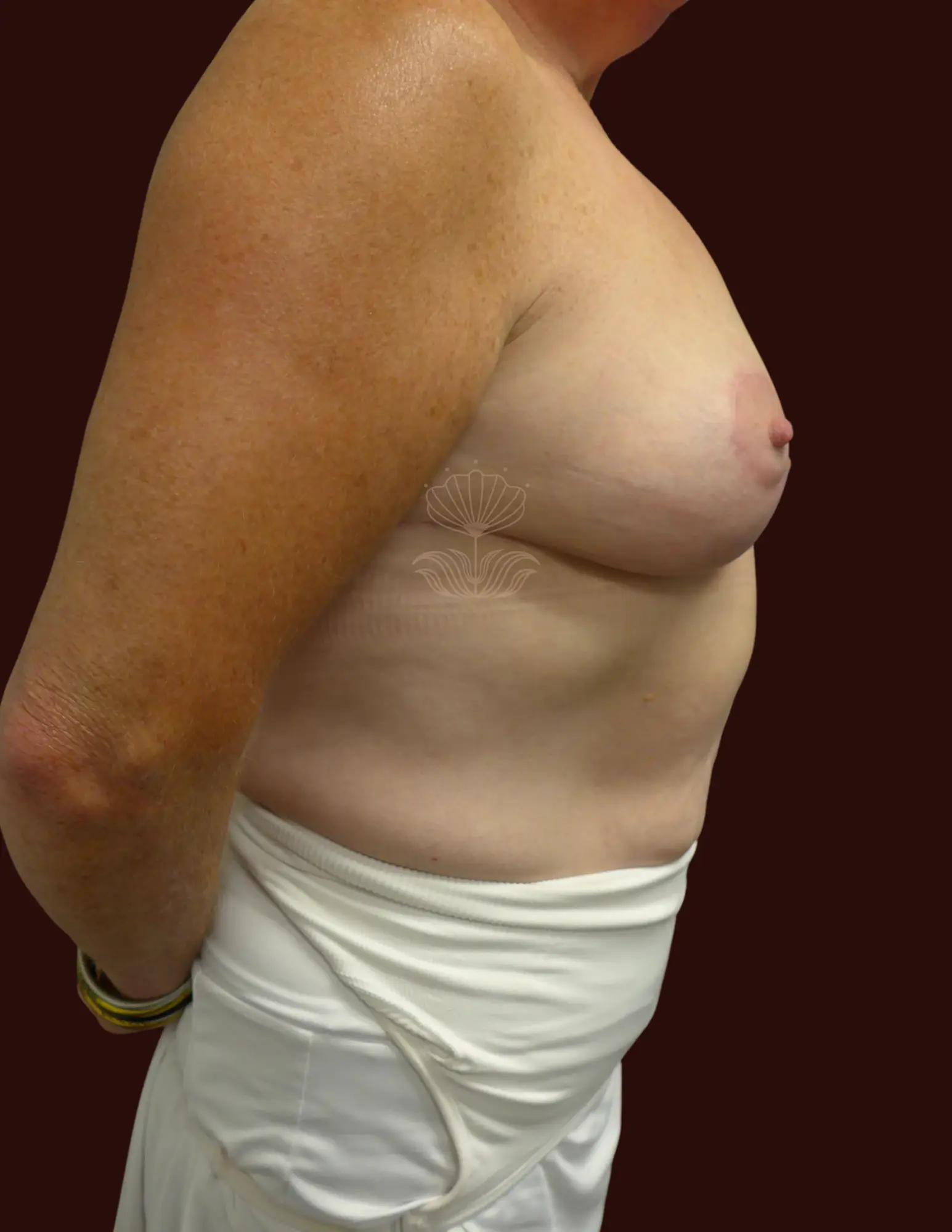 Suma Maddox, MD breast lift after — New Orleans, LA