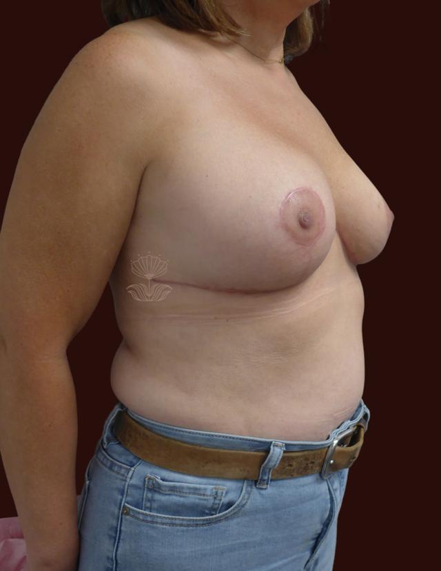 Breast Reduction after at Suma Maddox, MD in New Orleans, LA