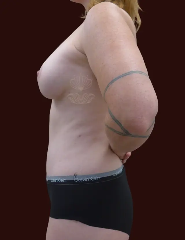 Mini Tummy Tuck after at Suma Maddox, MD in New Orleans, LA