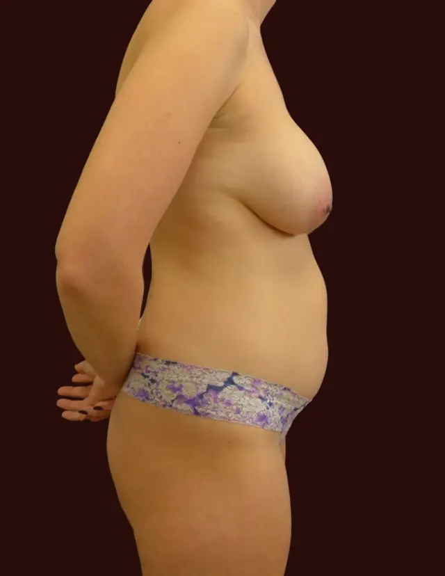 Mommy Makeover before at Suma Maddox, MD in New Orleans, LA