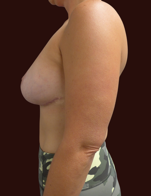 Breast Lift after at Suma Maddox, MD in New Orleans, LA