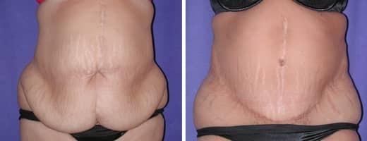 St. Charles Plastic Surgery tummy tuck result — St. Charles, IL