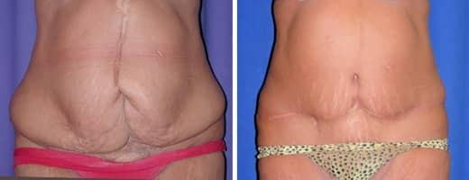 St. Charles Plastic Surgery tummy tuck result — St. Charles, IL