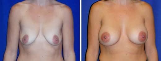 St. Charles Plastic Surgery breast augmentation result — St. Charles, IL