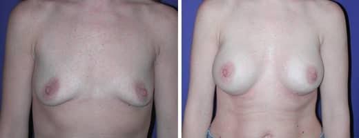 St. Charles Plastic Surgery breast augmentation result — St. Charles, IL
