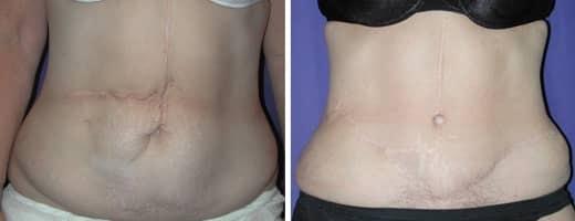 St. Charles Plastic Surgery tummy tuck result — St. Charles, IL