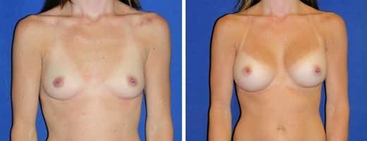 St. Charles Plastic Surgery breast augmentation result — St. Charles, IL