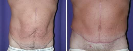 St. Charles Plastic Surgery tummy tuck result — St. Charles, IL
