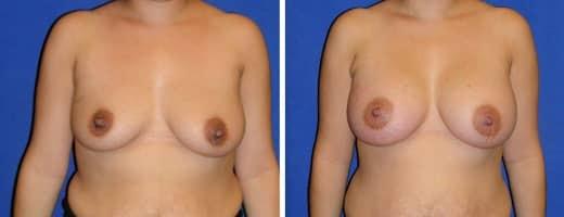 St. Charles Plastic Surgery breast augmentation result — St. Charles, IL