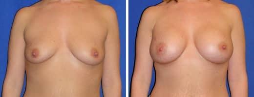 St. Charles Plastic Surgery breast augmentation result — St. Charles, IL