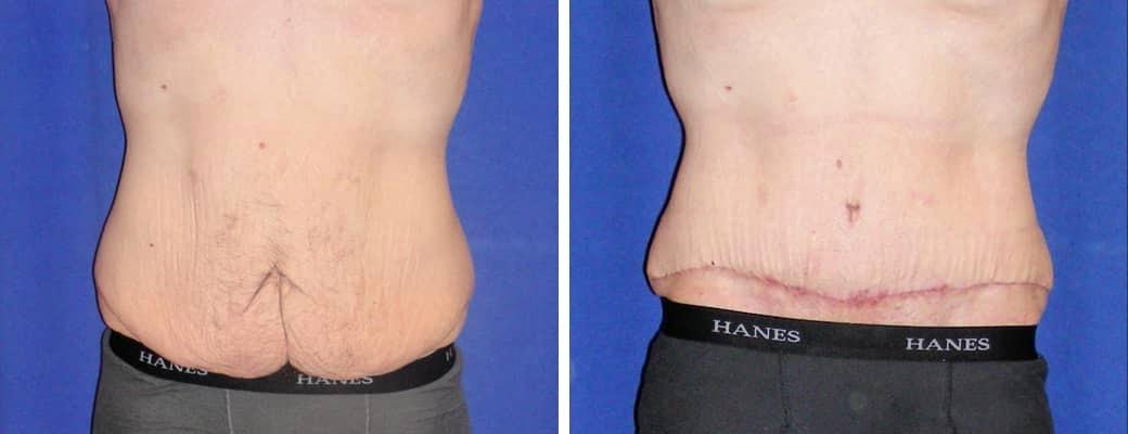 St. Charles Plastic Surgery tummy tuck result — St. Charles, IL