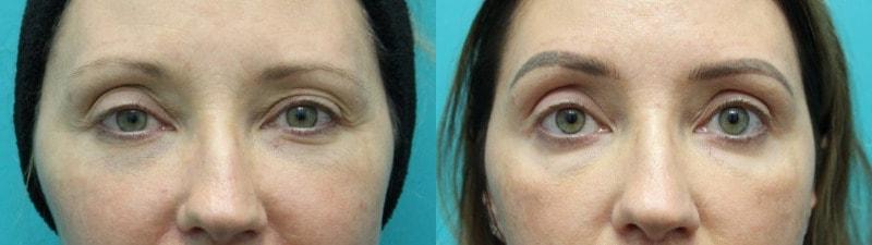 Modern Surgical Arts of Denver brow lift result — Highlands Ranch, CO