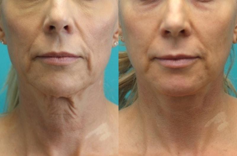 Modern Surgical Arts of Denver neck lift result — Highlands Ranch, CO