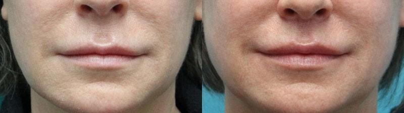 Modern Surgical Arts of Denver lip lift result — Highlands Ranch, CO