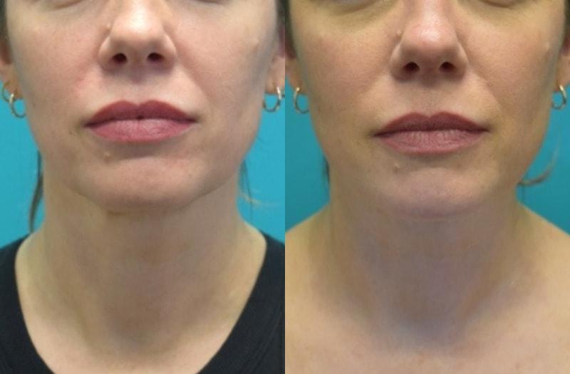 Modern Surgical Arts of Denver neck lift result — Highlands Ranch, CO