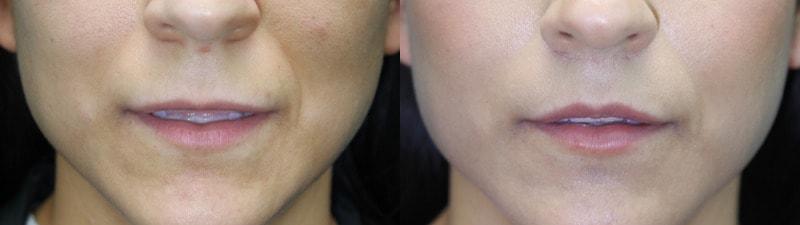 Modern Surgical Arts of Denver lip lift result — Highlands Ranch, CO